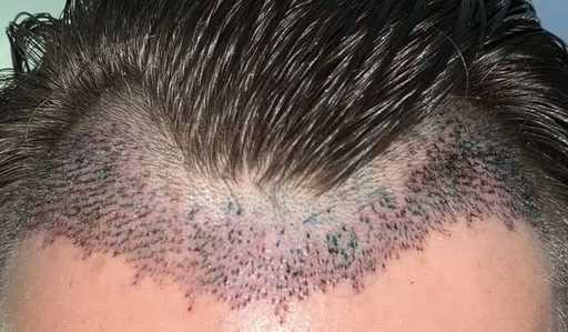 hair-shedding-after-hair-transplant-surgery-1.jpg